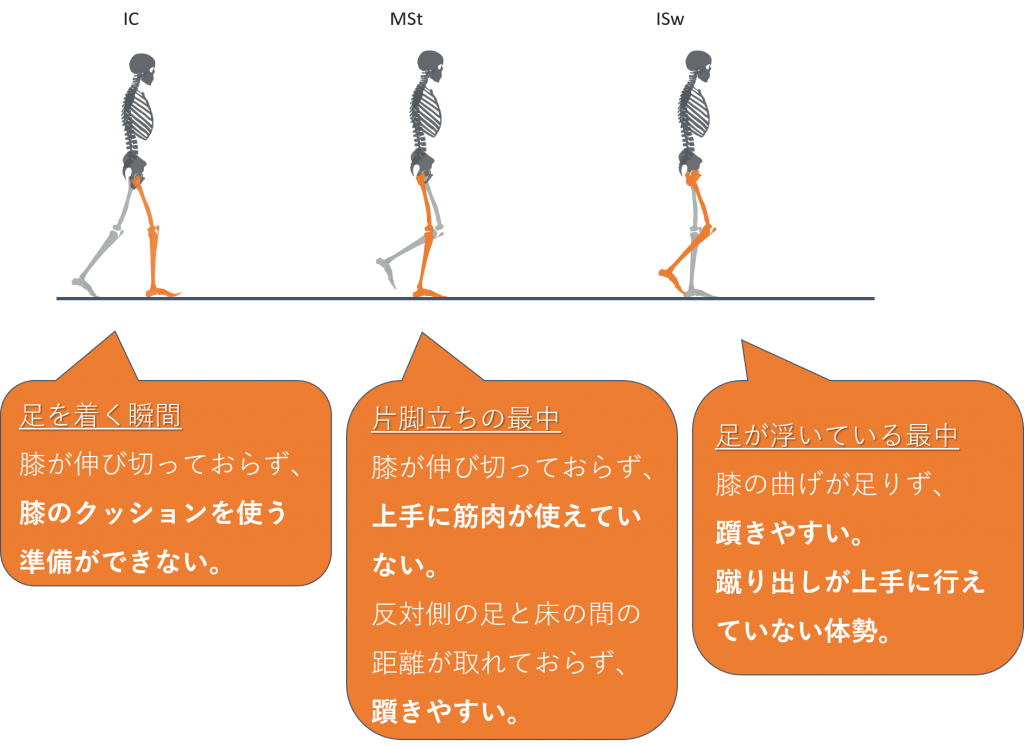 変形性膝関節症による膝の痛み O脚変形の軽減と予防が大切