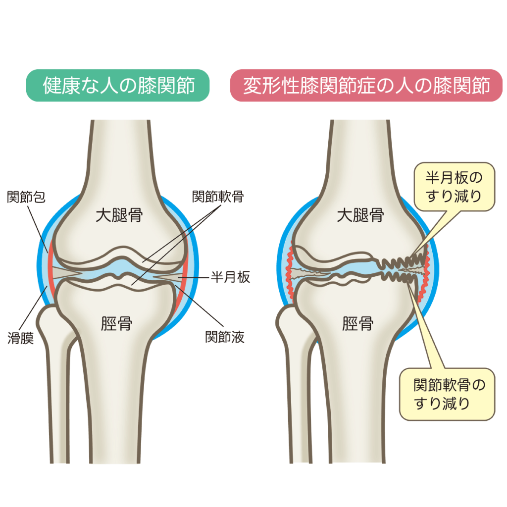 変形性膝関節症による膝の痛み O脚変形の軽減と予防が大切