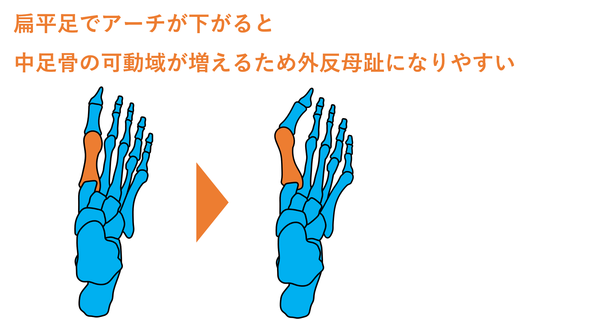 外反母趾 中足骨内転による母趾外転 | 株式会社RIKI