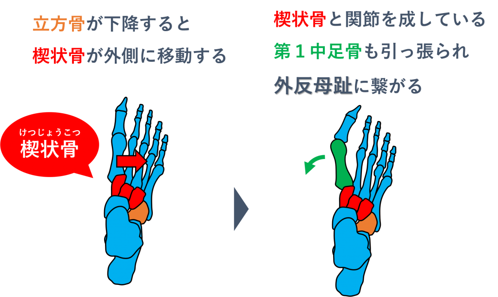 外反母趾とは アーチの崩れから外反母趾は進行する