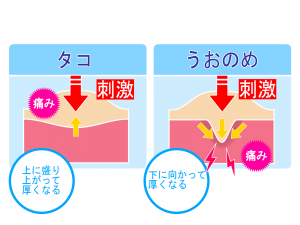 足のタコが痛い 削ってもすぐできる原因と対策