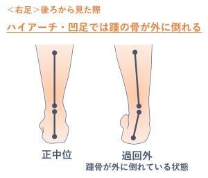 ハイアーチ 凹足とは 合併疾患が多い危険な足部状態 必須対策