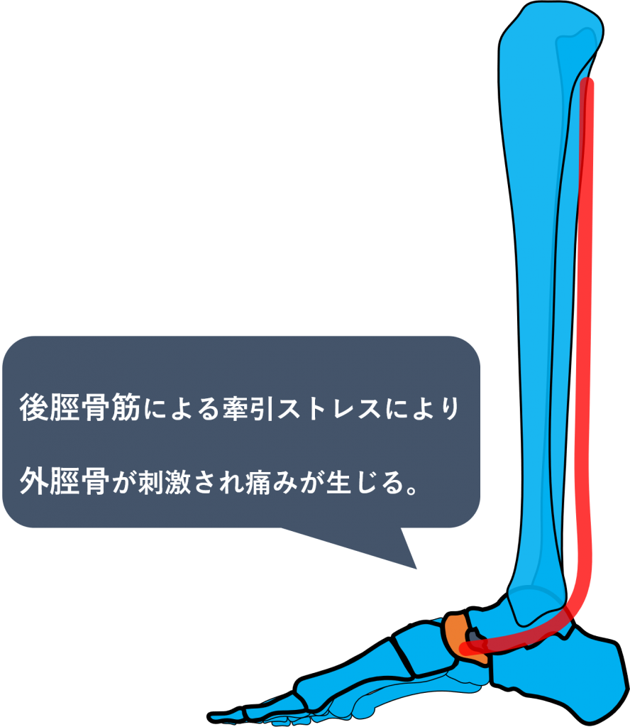 有痛性外脛骨とは 思春期に多い足の内側の痛み