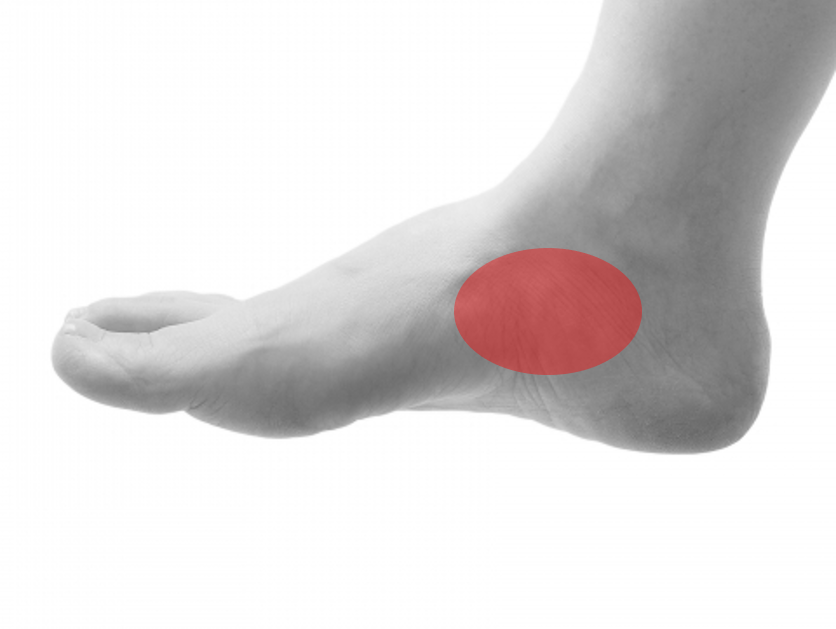 有痛性外脛骨とは 思春期に多い足の内側の痛み