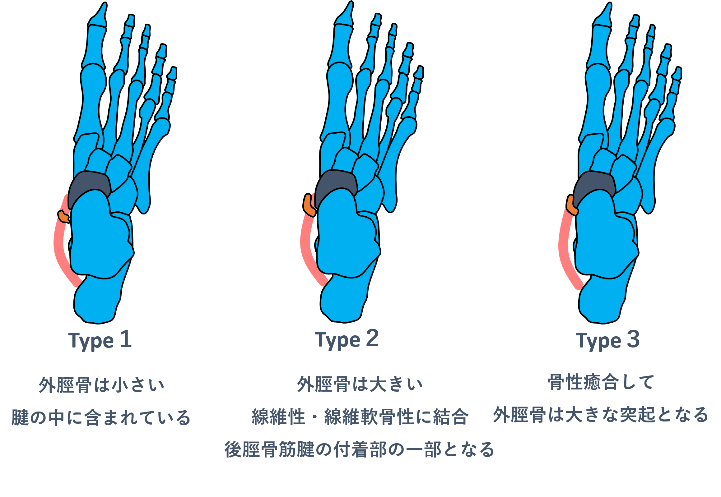 有痛性外脛骨 - ASportsの日記