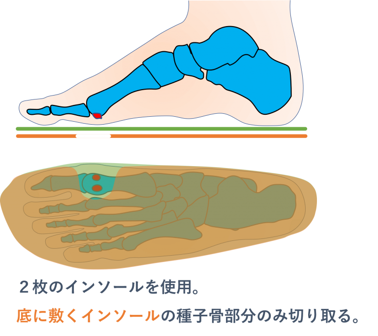 種子骨炎 種子骨障害の原因と対策とは インソール