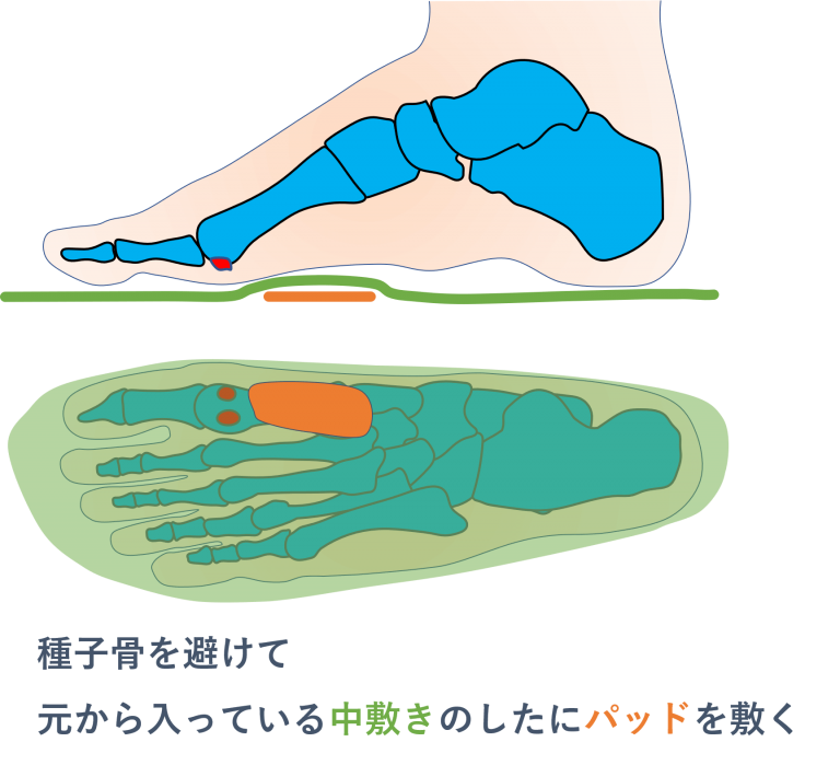 種子骨に負担がかかりにくくなる応急処置