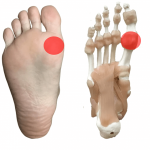 足の裏のしこり 足底線維腫の原因と対策とは