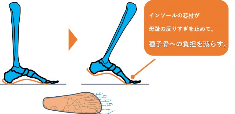 種子骨炎 種子骨障害の原因と対策とは インソール